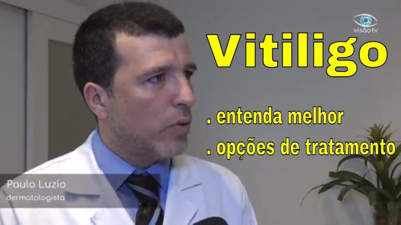 Aroldo Machado entrevista o especialista em vitiligo, Dr. Paulo Luzio