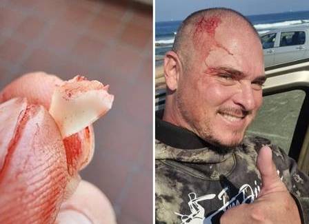 Pescador encontra dente de tubarão em ferimento após ser atacado em alto-mar
