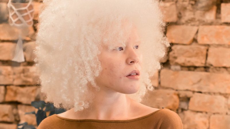 Jovem albina é aprovada em 1º lugar para psicologia na USP por meio do sistema de cotas
